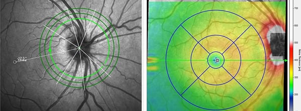 ParkinsonEye-enews